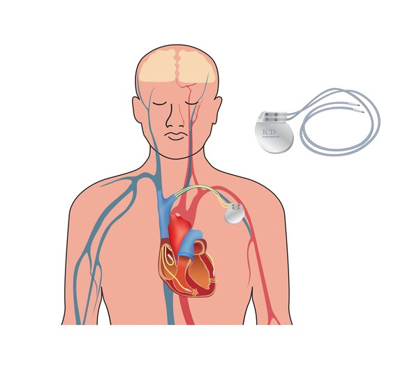 Ilustração de como é o aparelho desfibrilador cardíaco que os jogadores estão usando.